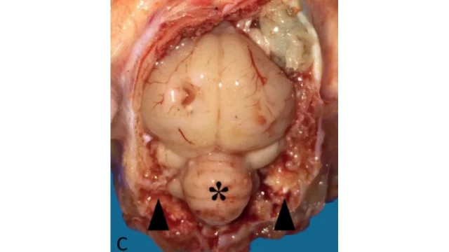 Clinical partial symptoms Type C
